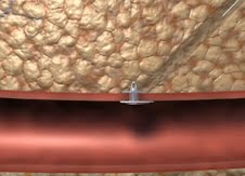 The FastSeal Bioabsorbable Vascular Access Closure System